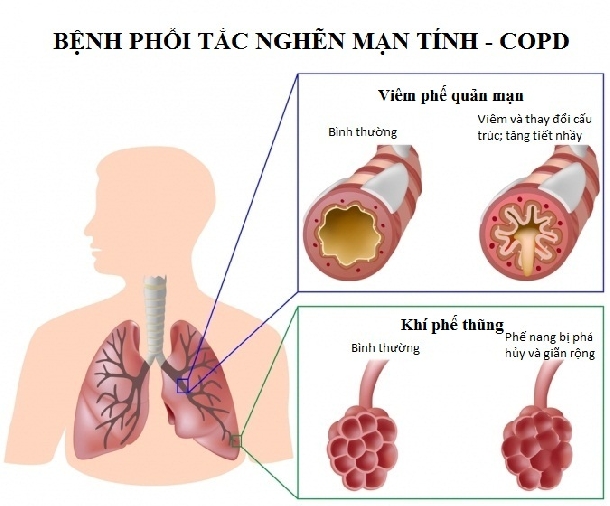 Điều trị Hen Suyễn, Hen Phế Quản, COPD bằng đông y