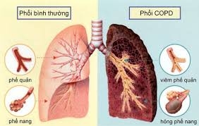 Điều trị phổi tắc nghẽn mạn tính (COPD) bằng Đông y