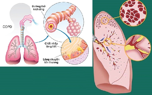 CHỮA DỨT ĐIỂM VIÊM PHỔI TẮC NGHẼN COPD BẰNG THUỐC ĐÔNG Y